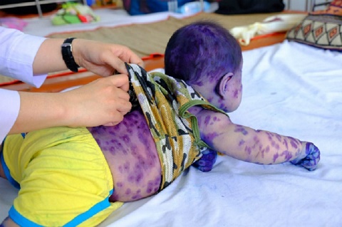 Dịch thủy đậu vào mùa ở phía Nam, nhiều em bé nhập viện