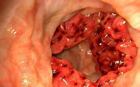 4 triệu người Việt mắc bệnh đại tràng: Thủ phạm có thể là món