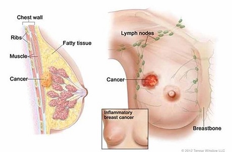 BV Ung bướu TP.HCM: Kỹ thuật sinh thiết khối u có hỗ trợ thiết bị hút chân không – Đánh bay những khối u tuyến vú, ít xâm lấn