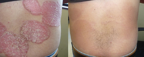 Kiểm soát hiệu quả bệnh vẩy nến bằng kết hợp thảo dược